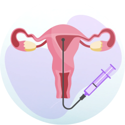 Intra Uterine Insemination
